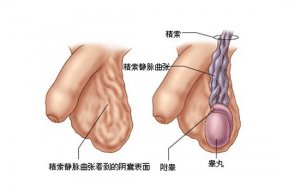 精索静脉曲张的有什么症状?